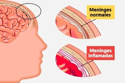 Meningitis