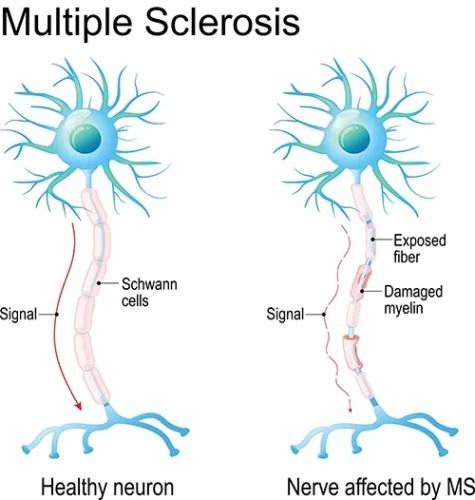 Esclerosis Múltiple