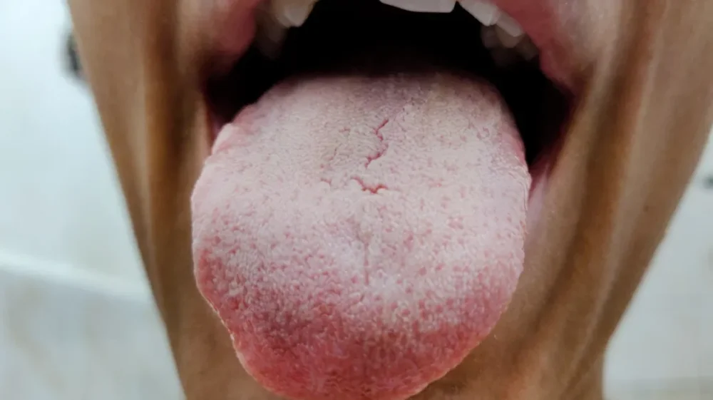 Por que tengo la lengua blanca