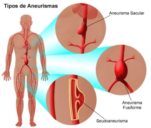 Aneurisma