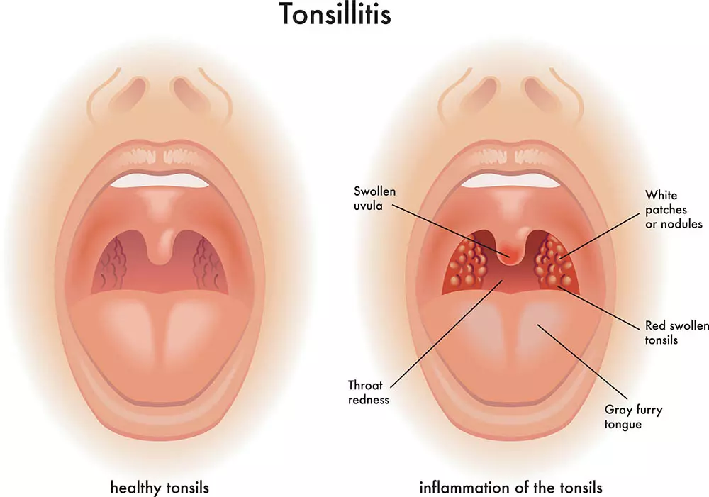 Tonsilolitos