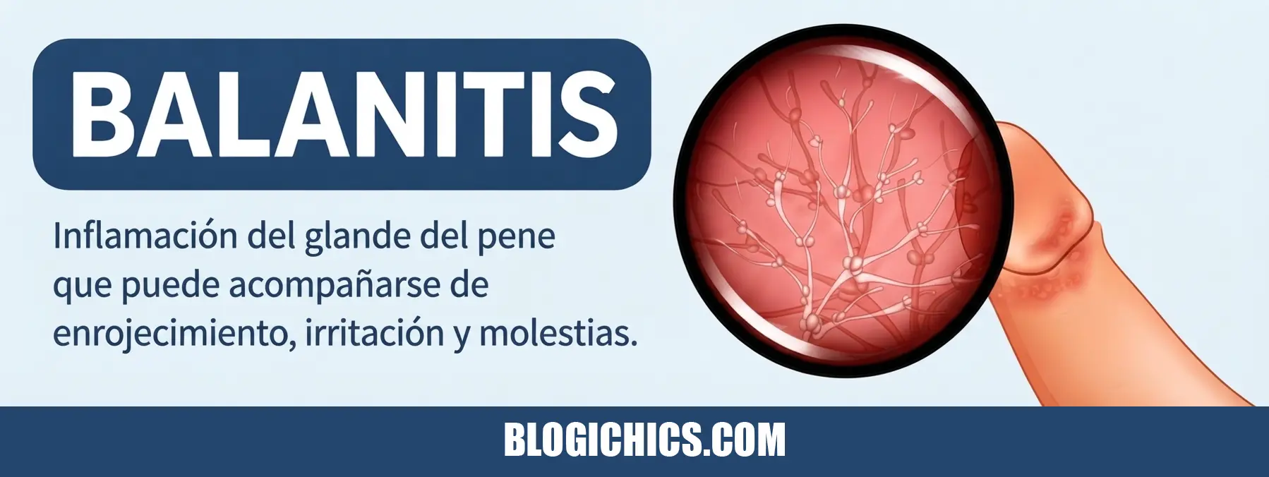 Balanitis