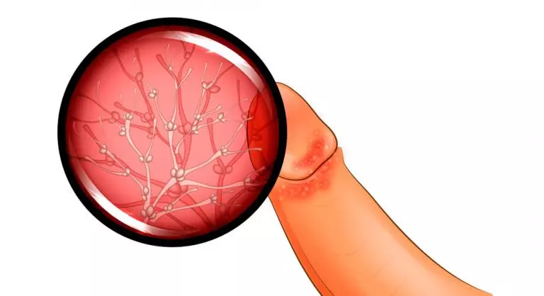 Balanitis Tratamiento