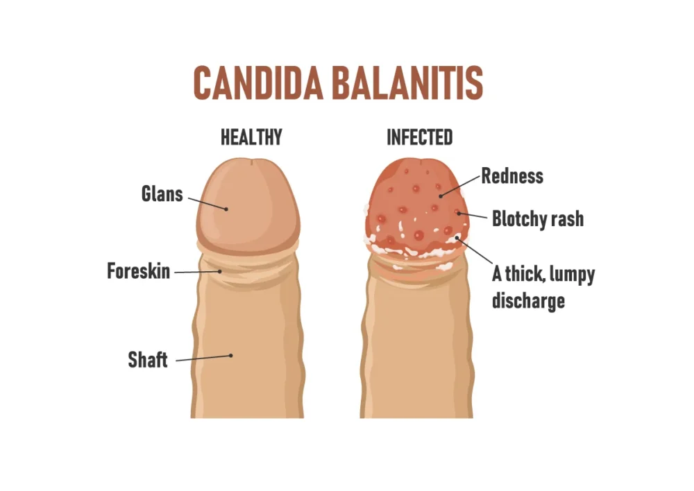 Balanitis Candidiásica
