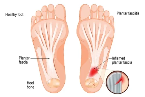 Fascitis Plantar