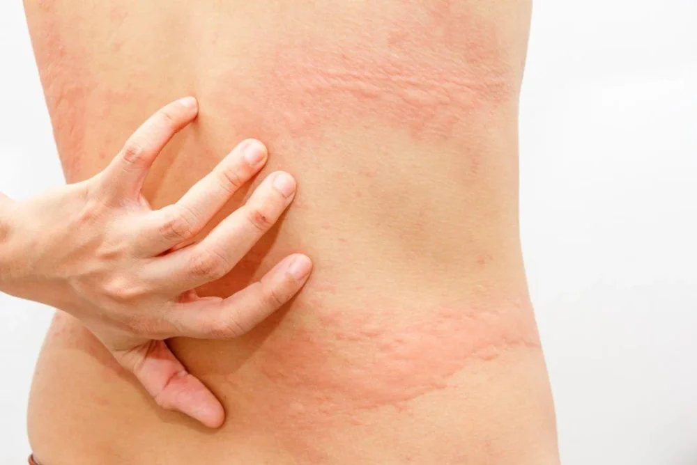 Urticaria Tratamiento
