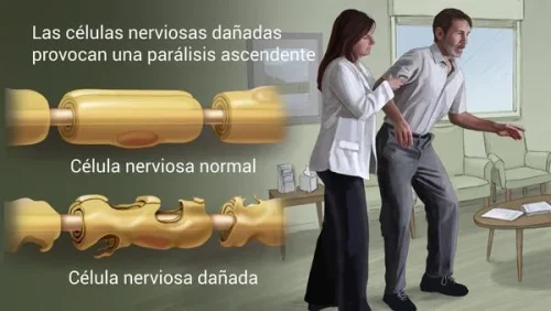 Síndrome de Guillain Barré