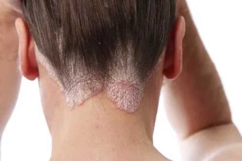 Dermatitis Seborreica