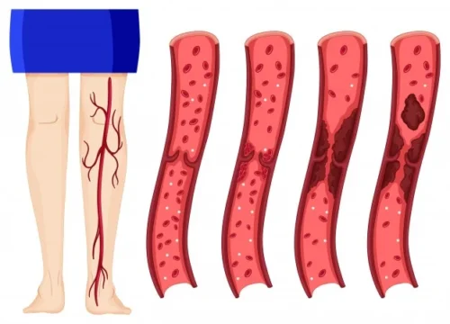 Trombosis